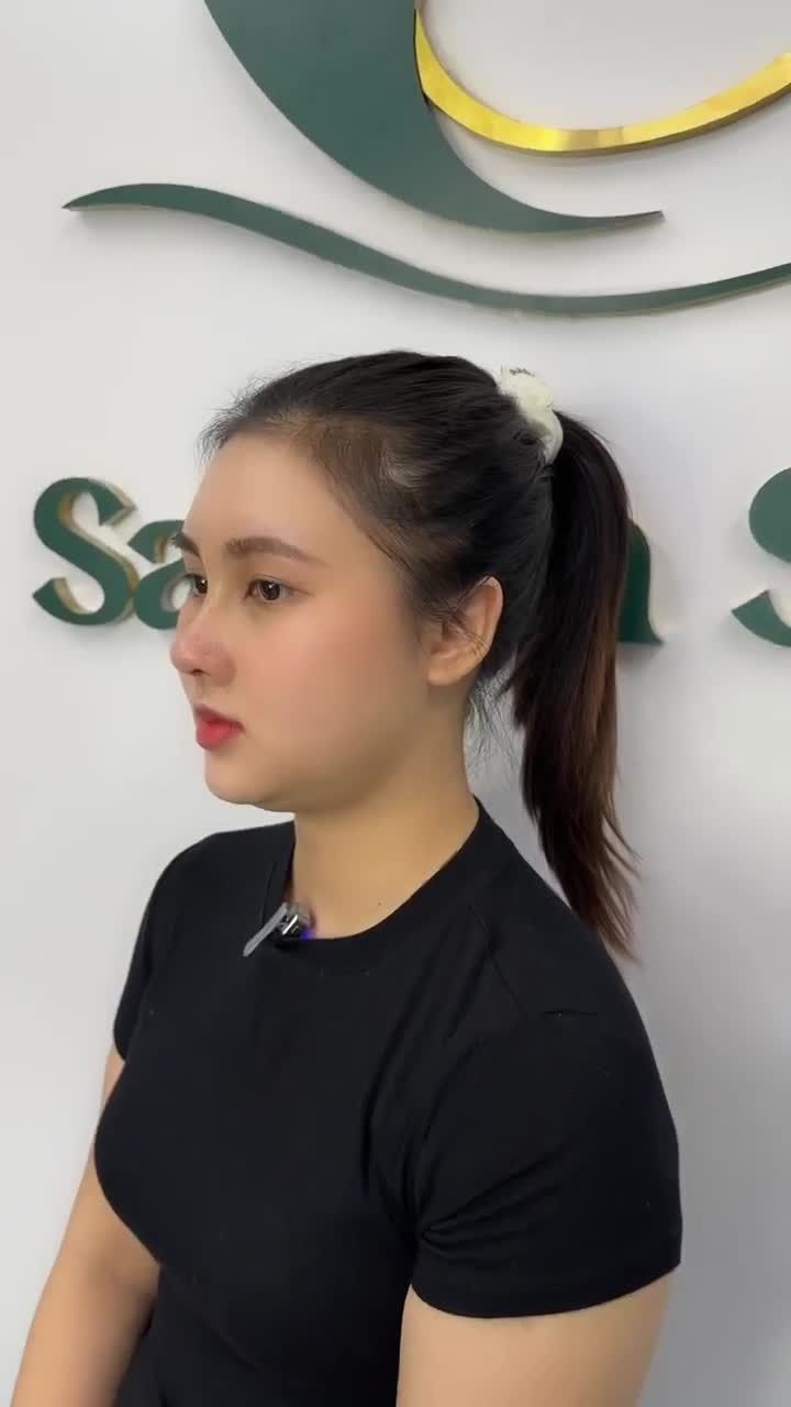 CẢM NHẬN THỰC TẾ SAU 12 NGÀY NÂNG MŨI CẤU TRÚC KH.TÂM ĐOAN (CÀ MAU)