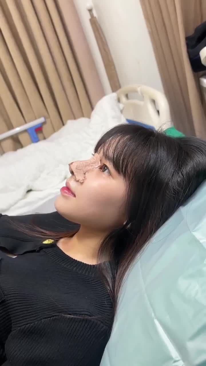 THÁO NẸP MŨI SAU 10 NGÀY DÁNG MŨI SẼ RA SAO ? CÙNG CHIÊM NGƯỠNG NHÉ!