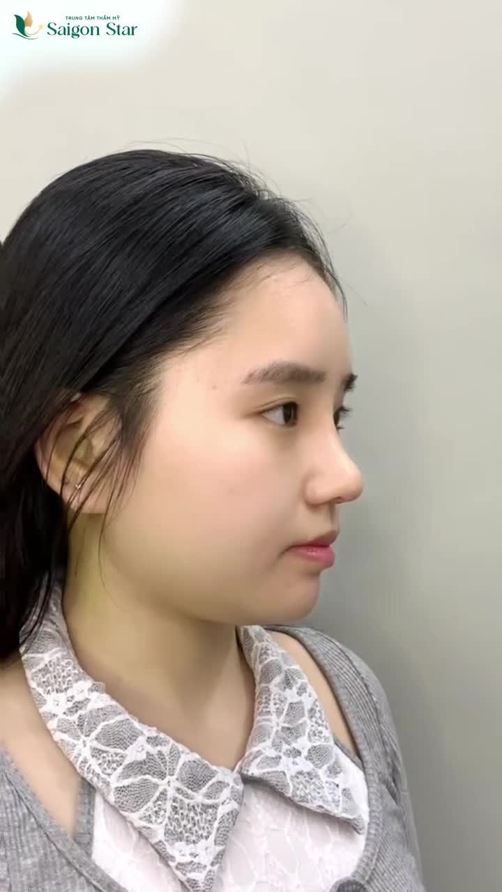 Bạn khách genZ của Saigon Star rạng rỡ chia sẻ ngay sau khi tháo nẹp mũi.
