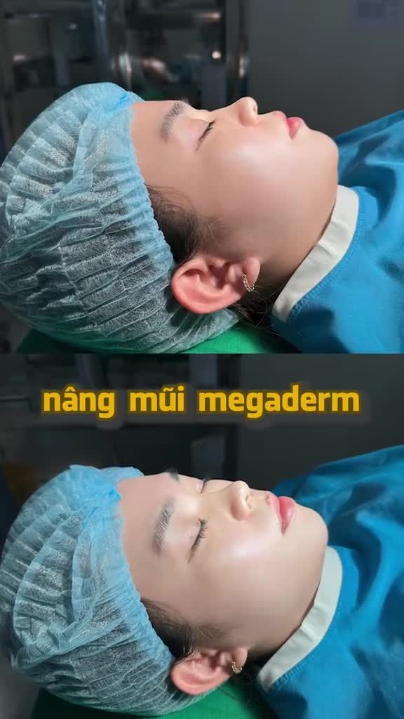 MŨI ĐẸP TỰ NHIÊN SAU KHI NÂNG MŨI MEGADERM