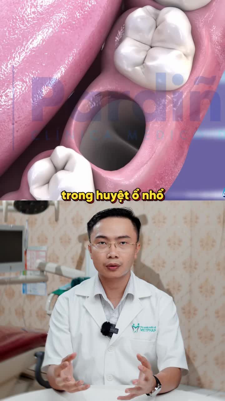 NHỔ RĂNG KHÔN BỊ VIÊM THÌ PHẢI XỬ LÝ NHƯ THẾ NÀO