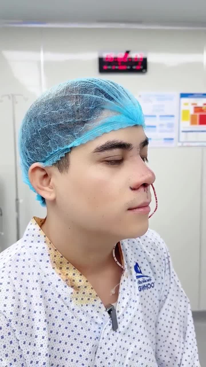 ANH Q.K. LỘT XÁC VỚI NÂNG MŨI CẤU TRÚC 3D TẠI GANGWHOO – DÁNG MŨI NAM TÍNH, DIỆN MẠO ĐỈNH CAO!
