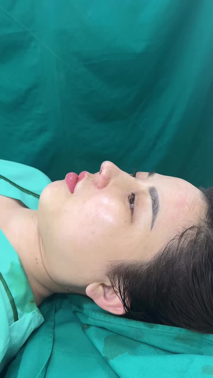 Case mũi cấu trúc vừa hoàn thành cho bạn gái đến từ Trà Vinh!!