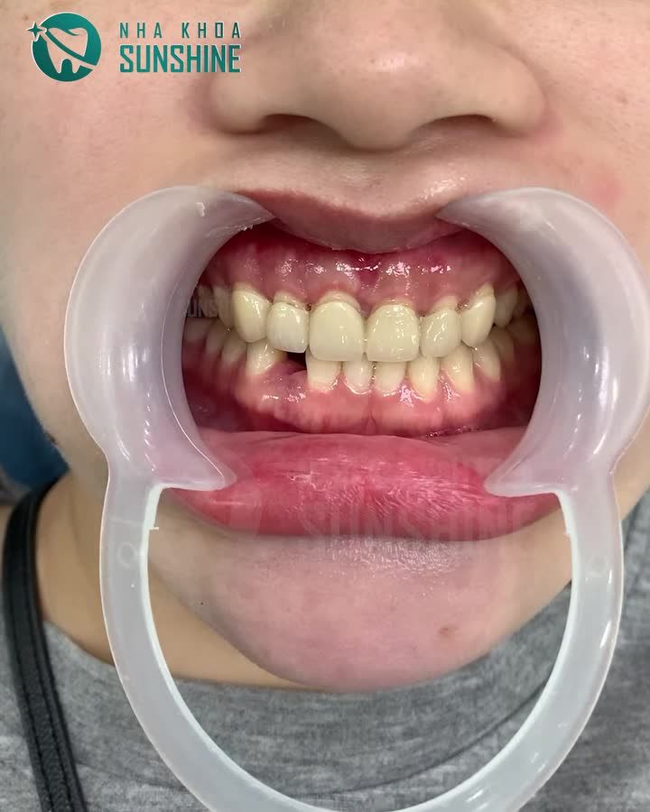 RĂNG SỨ HỎNG DO LÀM Ở NƠI KHÔNG UY TÍN