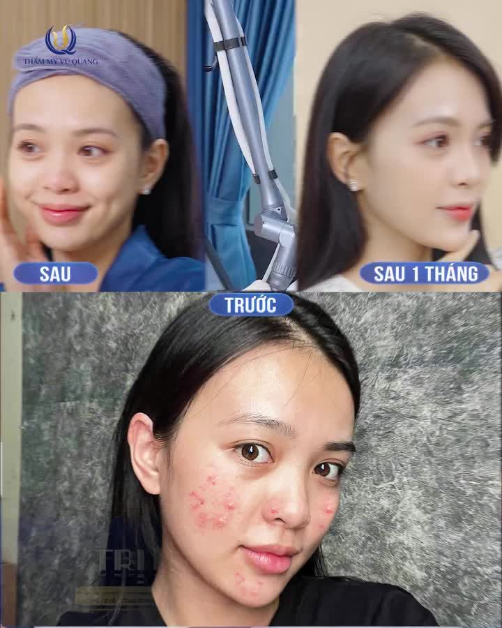 TRỊ MỤN CHUYÊN SÂU COMBO 9 BƯỚC chỉ với 250k