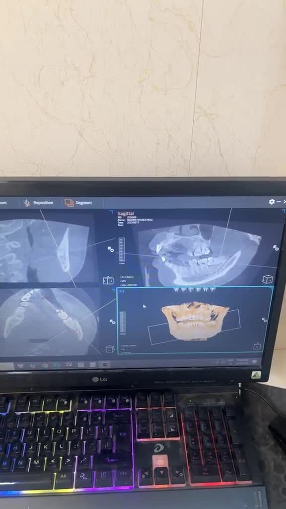 Ca nhổ răng khôn mọc ngang 90 độ