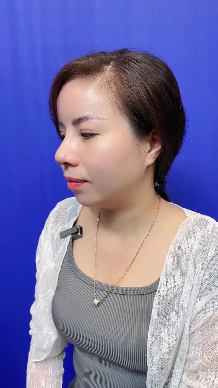 CHỊ KHÁCH HÀNG LỘT XÁC DIỆN MẠO SAU 1 THÁNG NÂNG MŨI TẠI BỆNH VIỆN THẨM MỸ GANGWHOO – DÁNG MŨI HOÀN HẢO, TỰ TIN TỎA SÁNG!