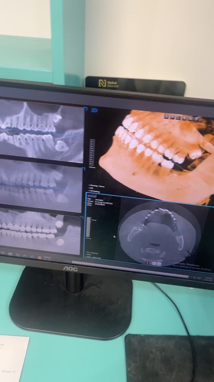 Ca nhổ răng khôn mọc ngầm nhẹ nhàng với máy Piezotome