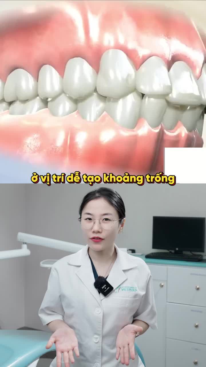 CÓ CẦN NHỔ RĂNG 4 KHI NIỀNG KHÔNG
