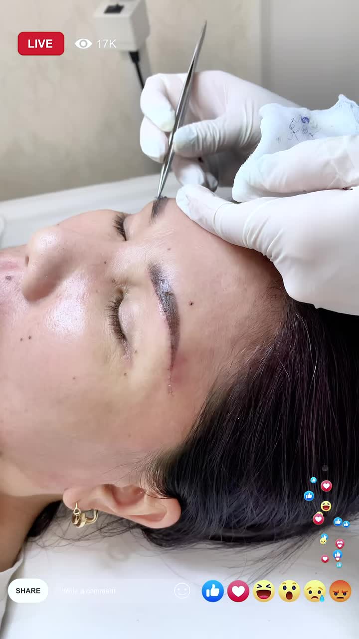 Ca cắt chỉ nâng cung chân mày của chị khách hàng U60