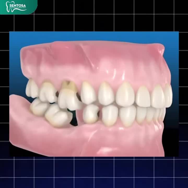 MẤT RĂNG – NHIỀU HẬU QUẢ KHÔN LƯỜNG HƠN BẠN NGHĨ!