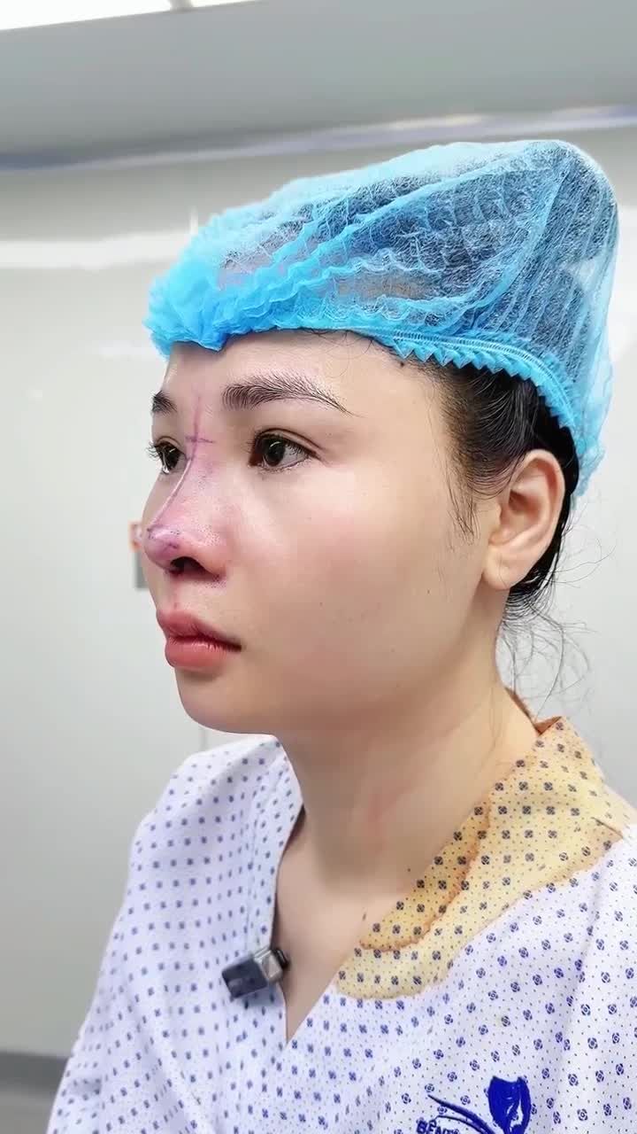 CÔ BẠN GEN Z  SAU 1 NĂM ĐẮN ĐO, CUỐI CÙNG CŨNG THỰC HIỆN NÂNG MŨI CẤU TRÚC TẠI BVTM GANGWHOO