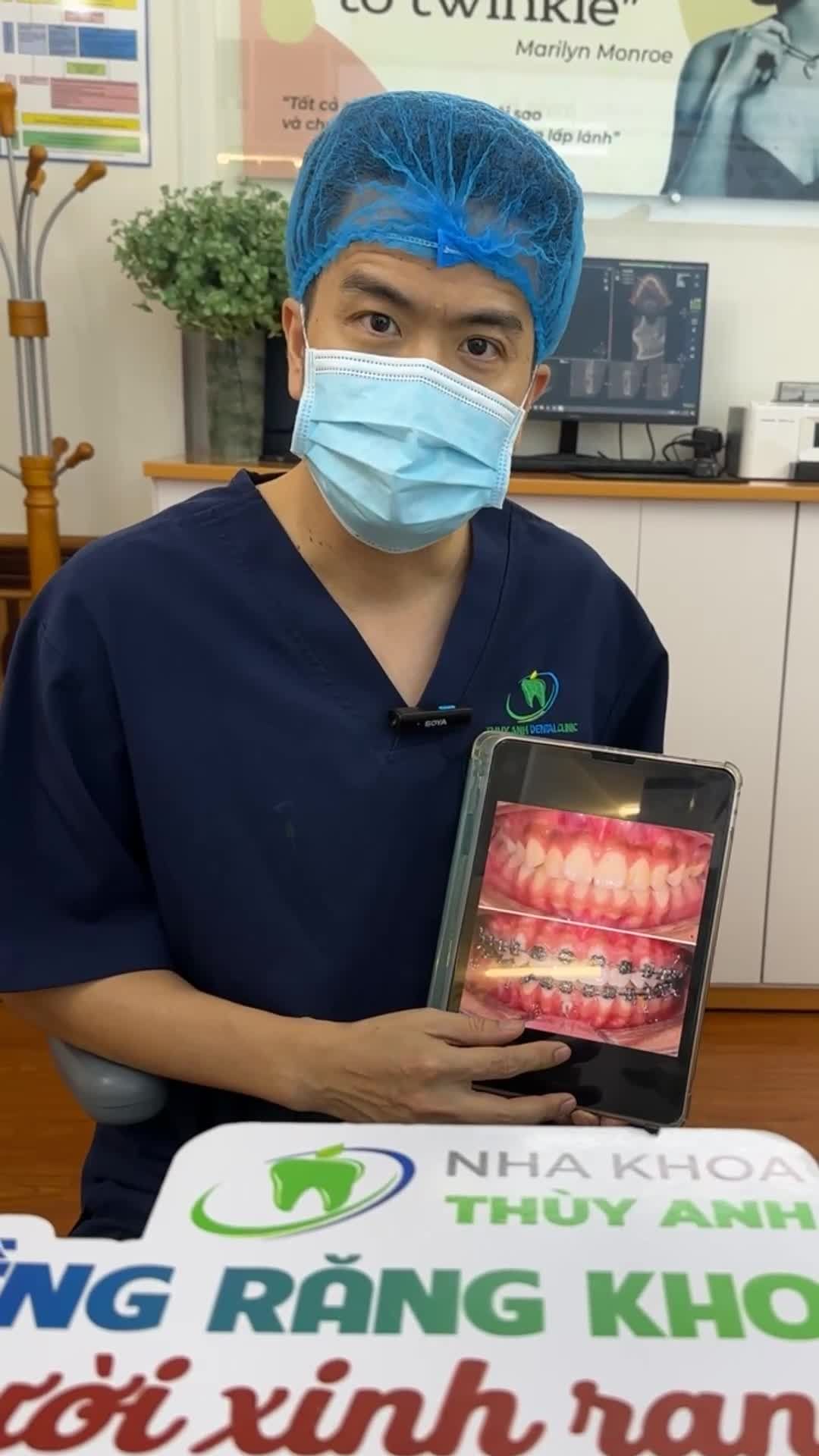 Phân tích quá trình chỉnh nha và tháo mắc cài cho bạn Vân gặp tình trạng răng hô, khấp khểnh tại Nha Khoa Thuỳ Anh