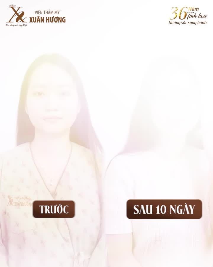 Hành trình LỘT XÁC của Miss Eco Tourism Global 2024 - Hoàng Hải Yến sau khi thực hiện combo nâng mũi và nhấn mí tại VTM Xuân Hương