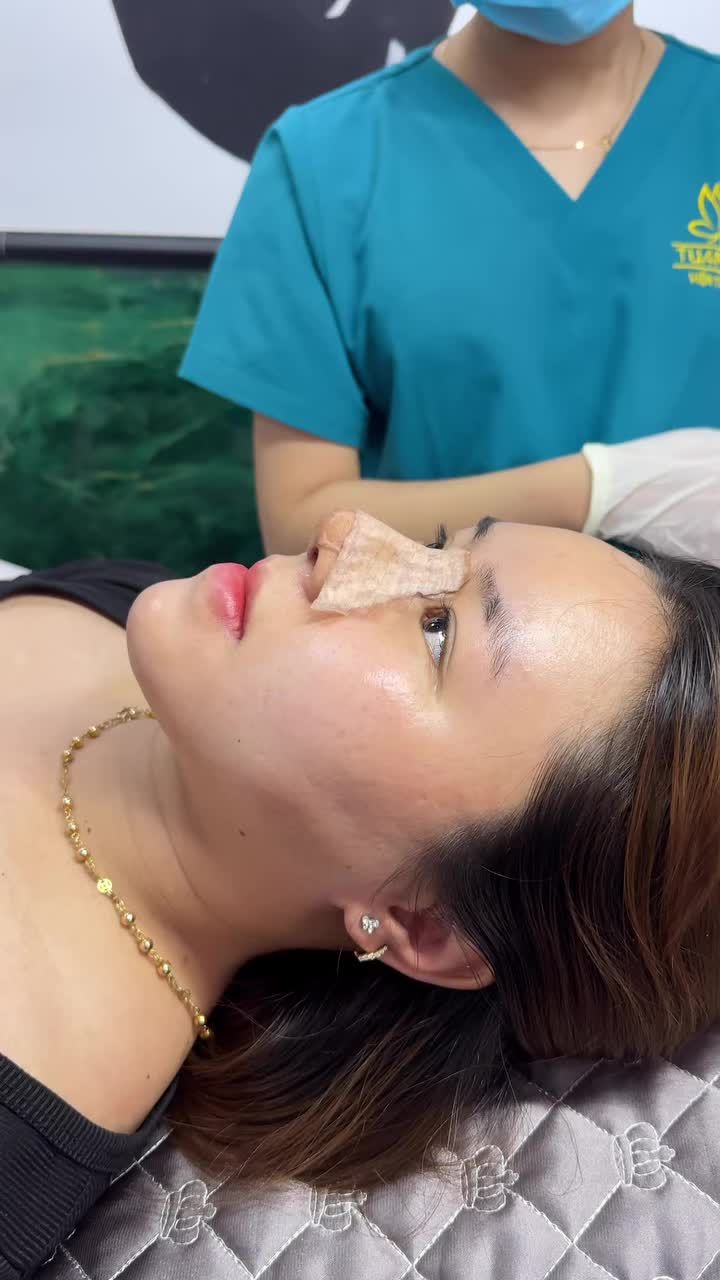 Case mũi cấu trúc sau 10 ngày