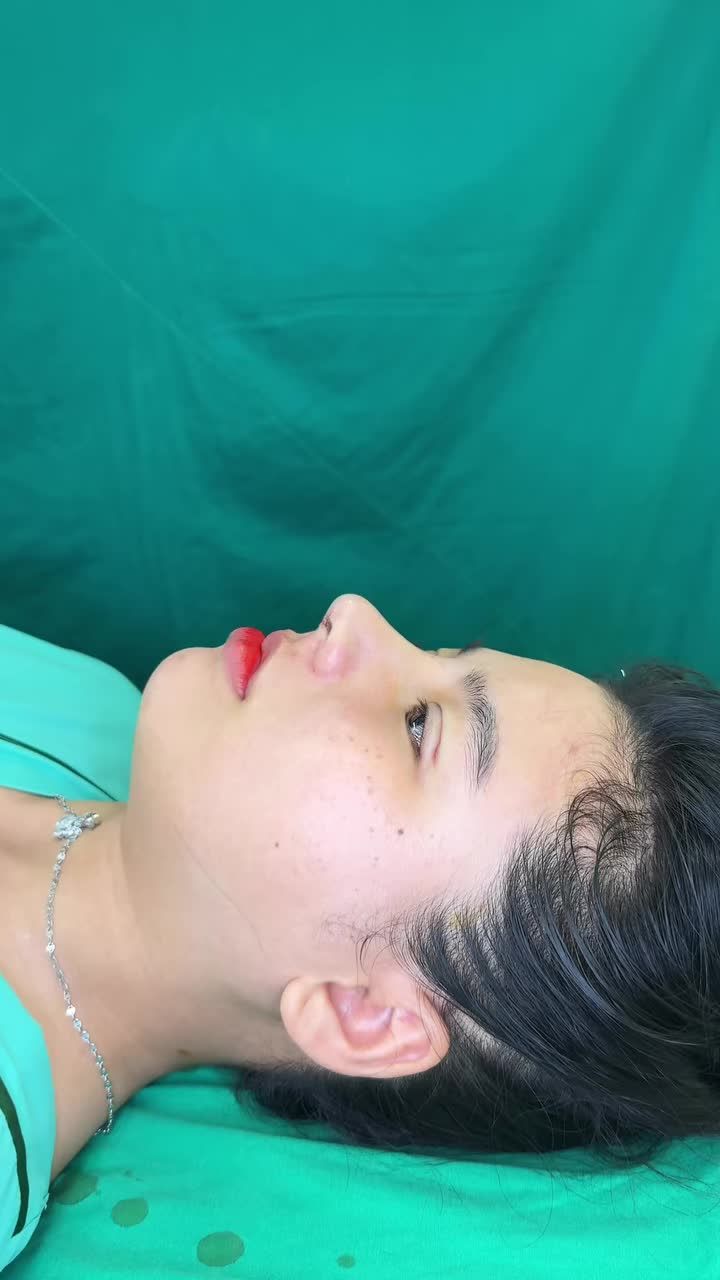 Combo nhấn mí + nâng mũi cấu trúc vừa hoàn thành!!