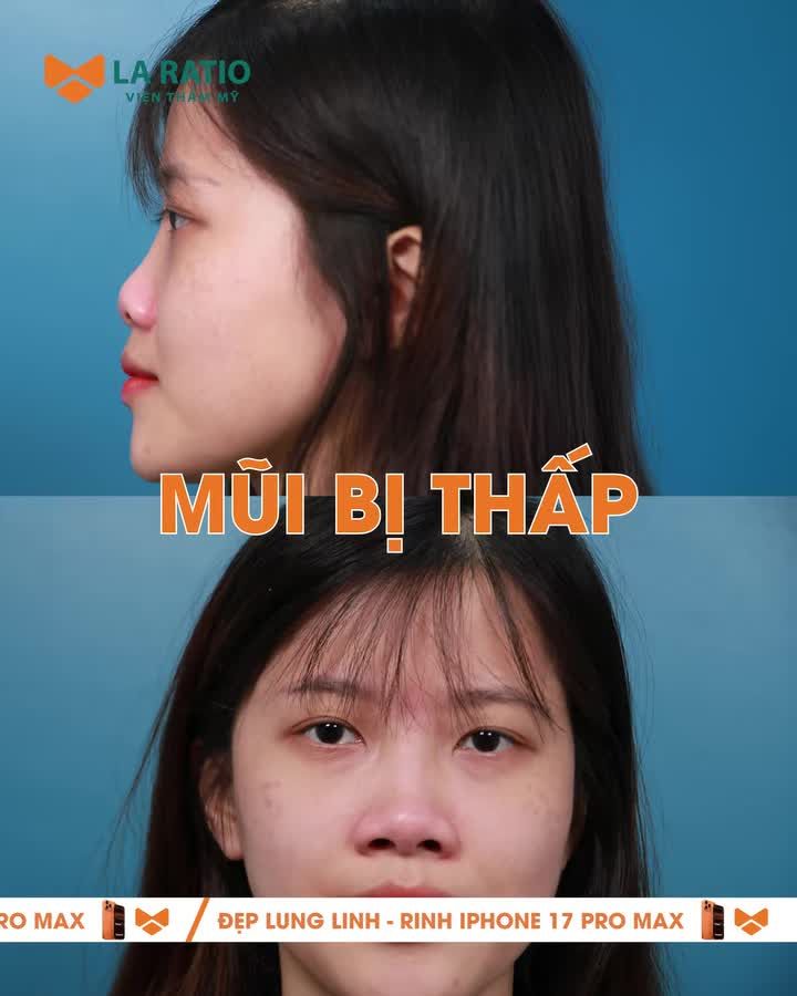 Từ "mũi tẹt, sống thấp" đến một phiên bản tự tin và tỏa sáng – bạn có dám thay đổi như Gia My?