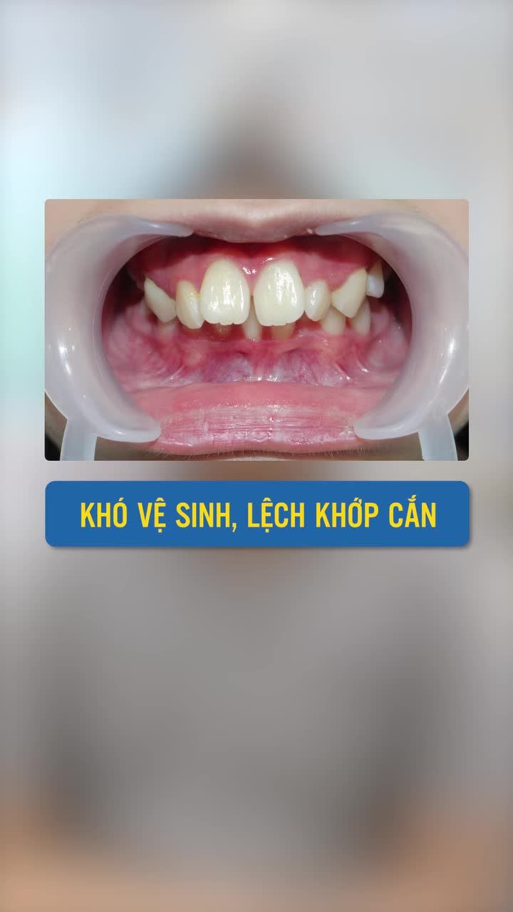 Niềng răng tác động cả sức khoẻ và diện mạo