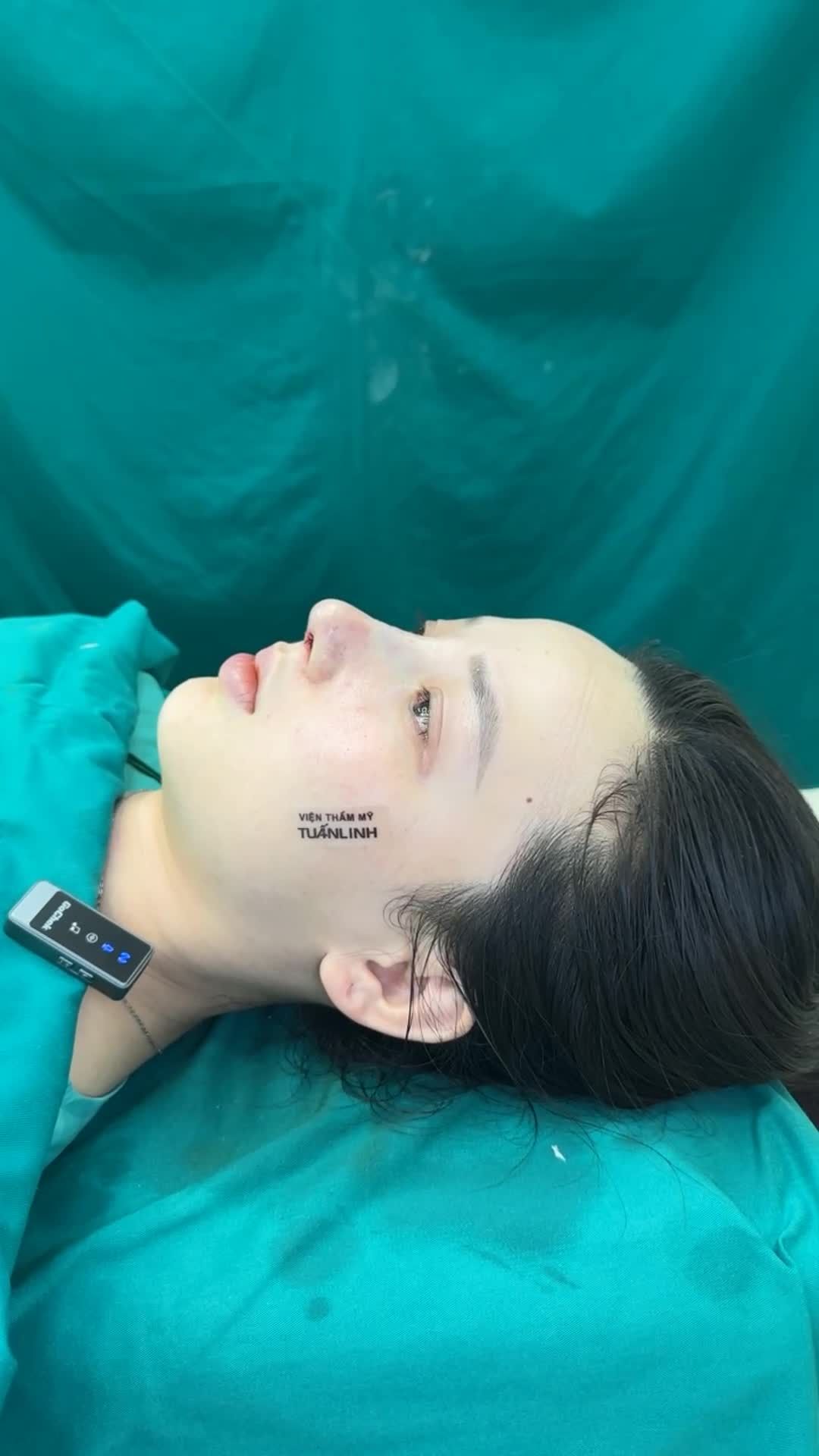 Mũi cấu trúc vừa hoàn thành - Dáng mũi hài hòa, tự nhiên!!