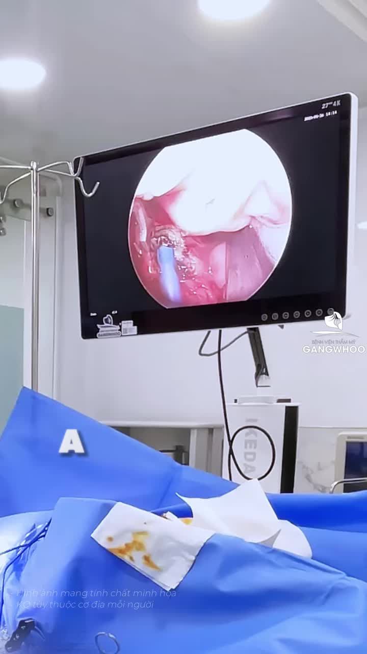 TOP CÔNG NGHỆ TRẺ HÓA VÙNG KÍN ĐƯỢC SẴN ĐÓN