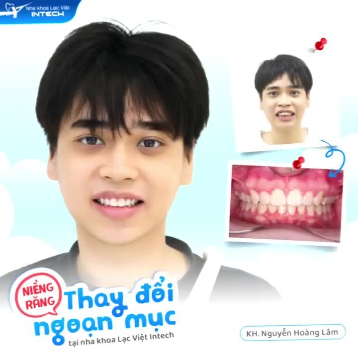Top 4 đồng niềng với màn lột xác cực kỳ thành công sau khi niềng răng tại Nha khoa Lạc Việt Intech