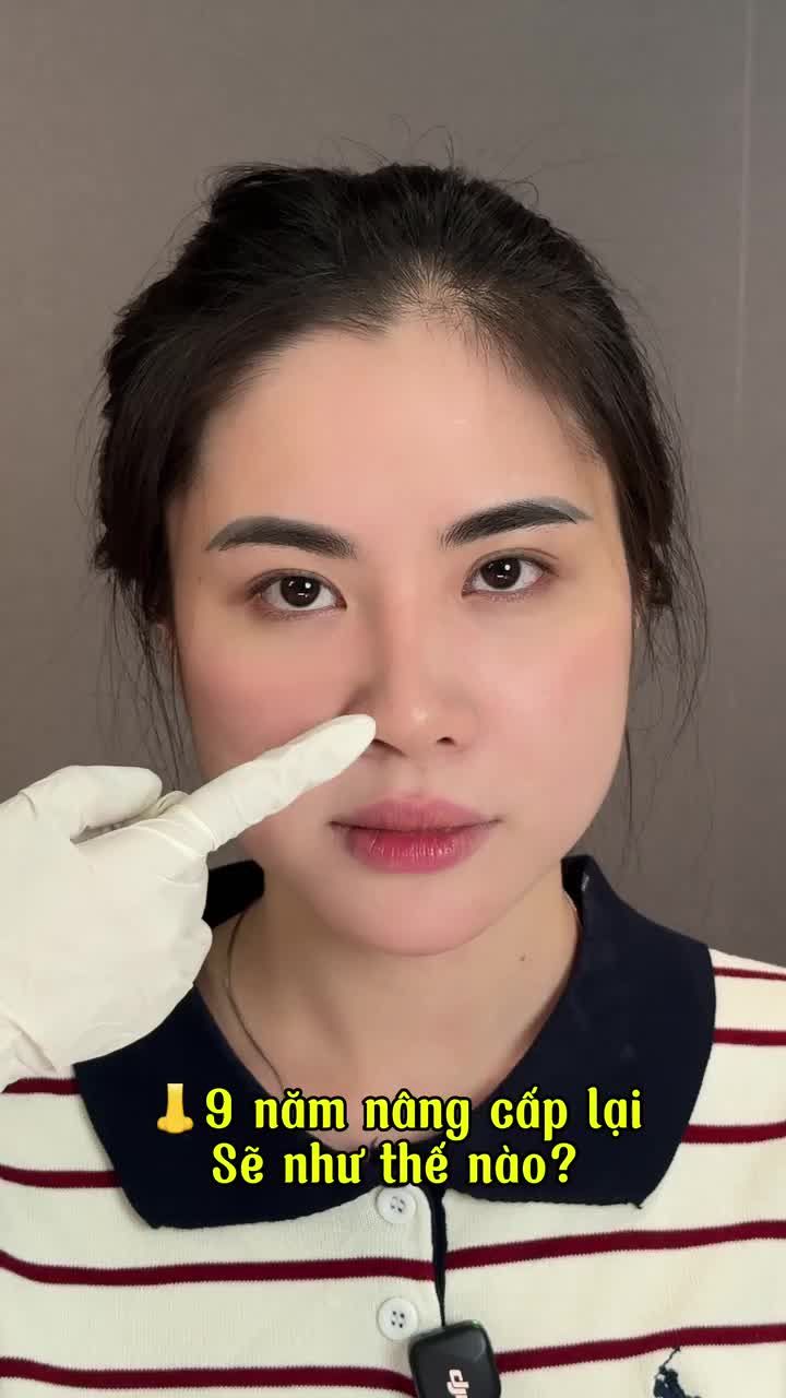 Nâng cấp mũi tại Tuấn Linh nhận thêm ƯU ĐÃI KHỦNG!!