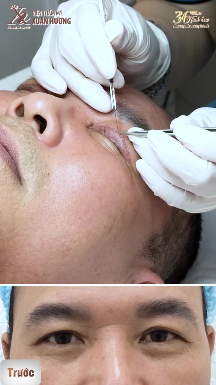 Nếp mí tròn đều – đẹp tự nhiên chỉ sau 5 ngày phẫu thuật tại VTM Xuân Hương