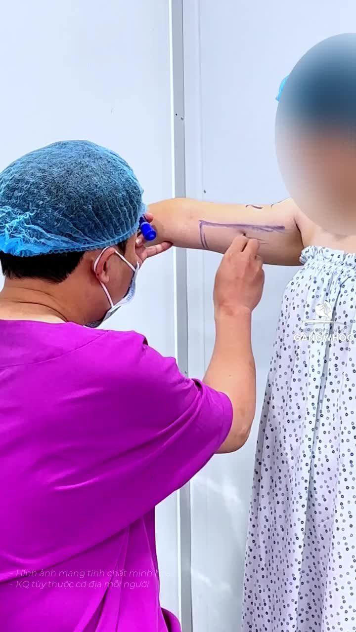 Tự ti vì bắp tay kém thon gọn không thể diện áo hai dây, chị khách đến Gangwhoo hút mỡ bắp tay