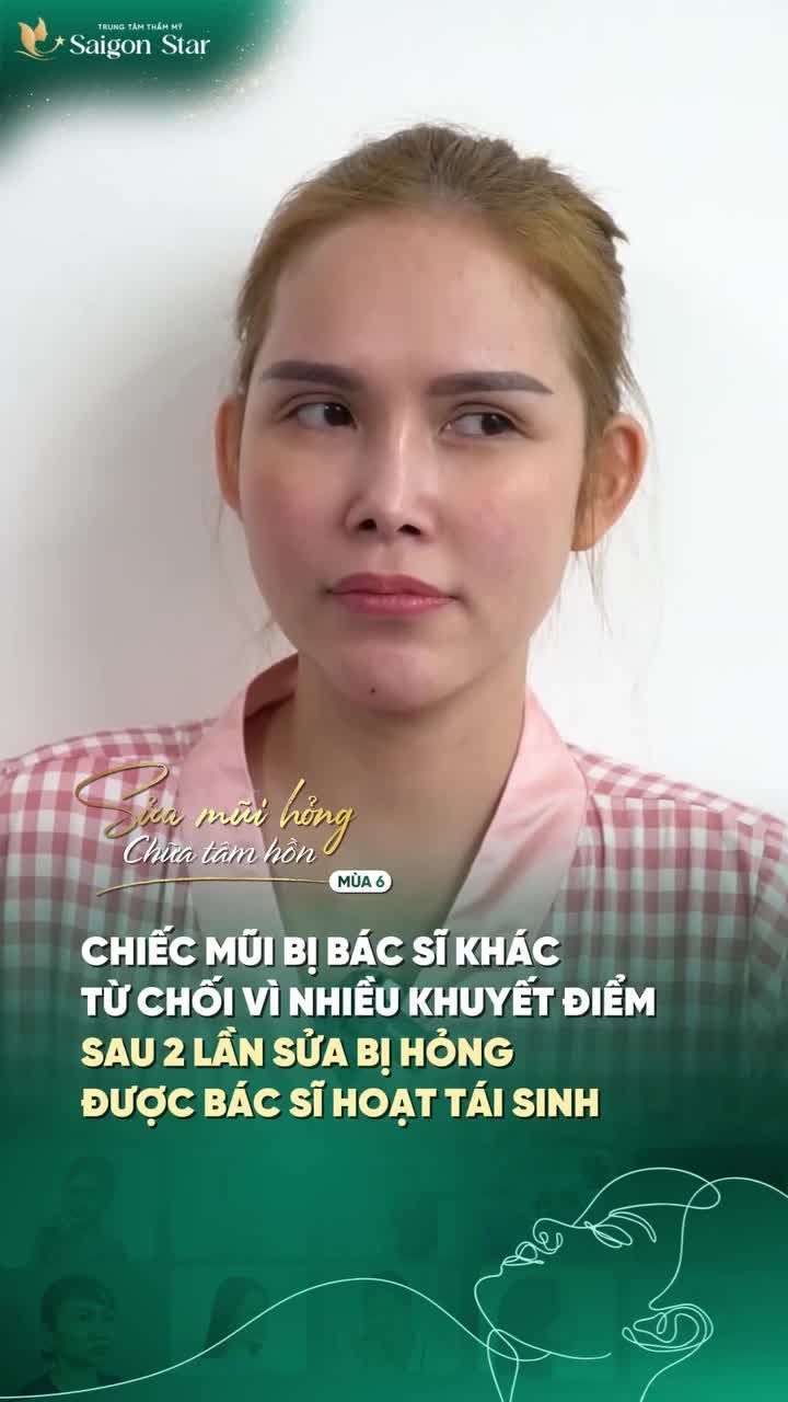 BỊ NHIỀU BÁC SĨ TỪ CHỐI VÌ MŨI HỎNG NẶNG SAU 2 LẦN NÂNG MŨI  KIỀU NƯƠNG ĐÃ ĐƯỢC BÁC SĨ HOẠT "TÁI SINH" TRONG DÁNG MŨI MỚI