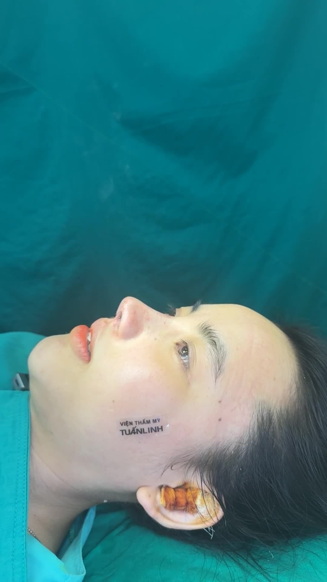 Case Nâng mũi tái cấu cho khách hàng đã từng sửa mũi cách đây 2 năm