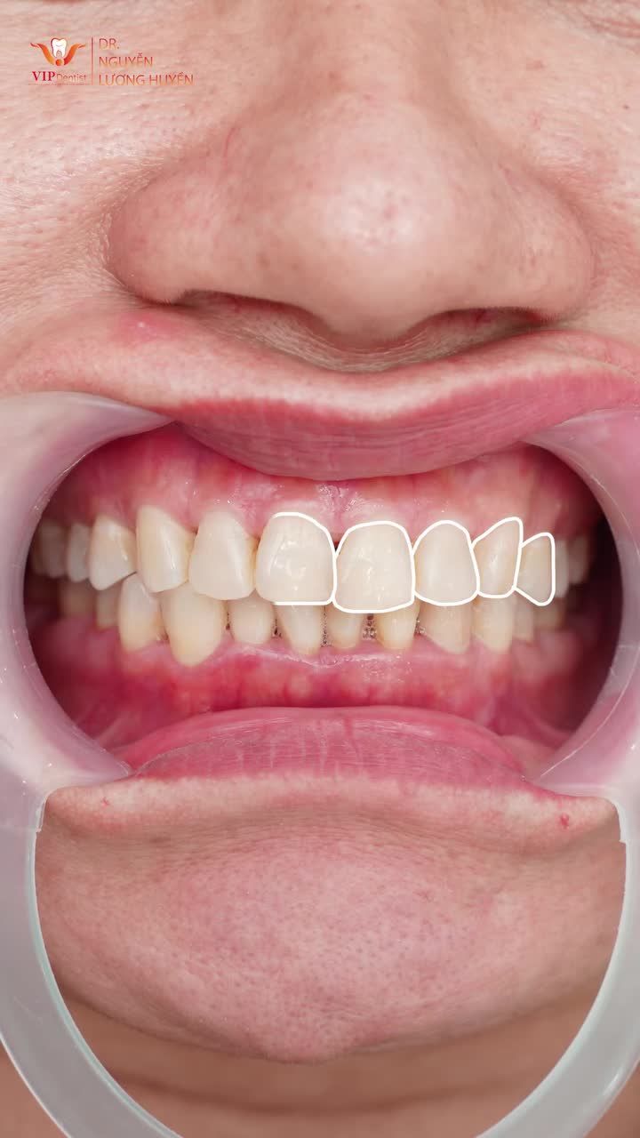 Tại VIP Dentist, chỉ sau 2 lần hẹn, chị nữ khách hàng đã sở hữu nụ cười trắng sáng – cân đối – tự nhiên hơn bao giờ hết