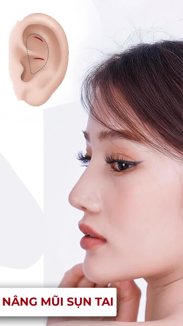 Nâng mũi bằng sụn tai. Nhiều khách thắc mắc sụn tai khi nâng mũi có lấy đi lấy lại được không?