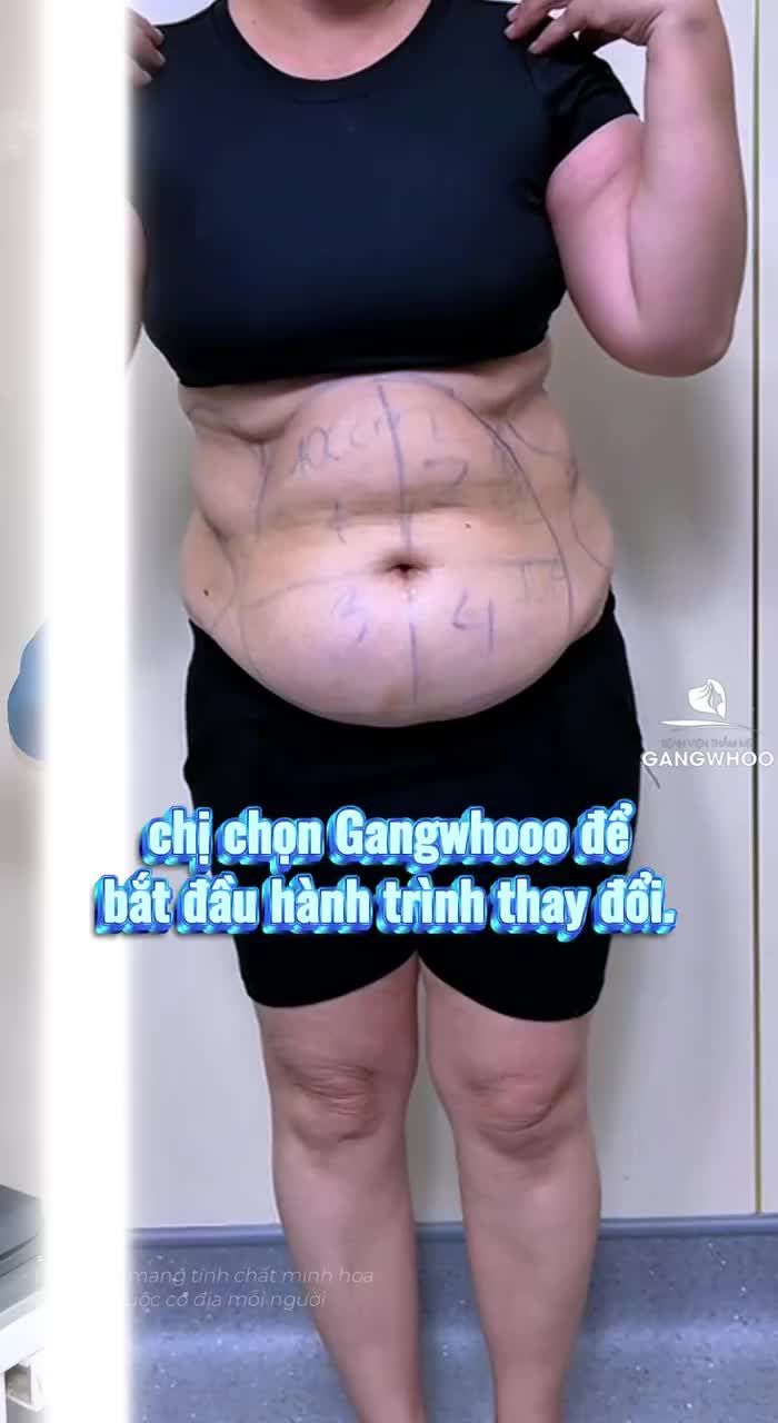 Sau 1 ngày làm combo dịch vụ hút mỡ, cắt da bụng, dời rốn chị khách có đau hay không?