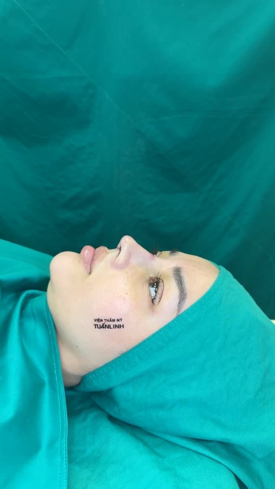 Case Nâng mũi nâng cấu trúc Surgiform vừa hoàn thành!!