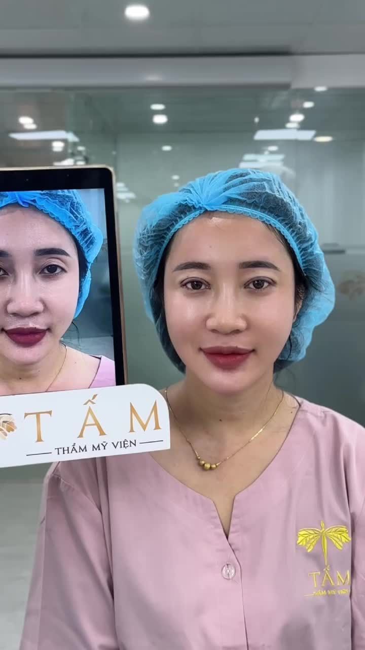 Lựa chọn combo Cắt Mí Trên và Cấy Mỡ đã giúp chị Xuân thay đổi thế nào?