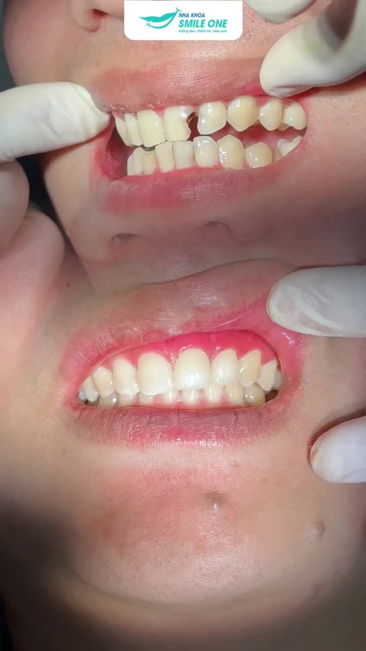 Sau bọc sứ thẩm mỹ vùng răng cửa, nụ cười của anh ấy đẹp như ngày giải phóng!