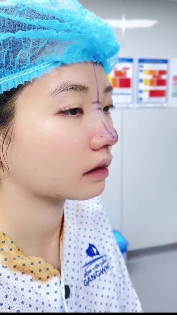CÔ BẠN GEN Z  SAU 1 NĂM ĐẮN ĐO, CUỐI CÙNG CŨNG THỰC HIỆN NÂNG MŨI CẤU TRÚC TẠI BVTM GANGWHOO