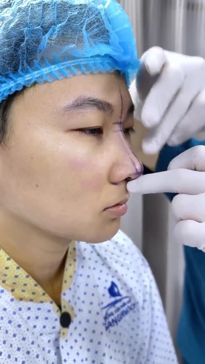 ĐỂ CÓ MỘT DÁNG MŨI ĐẸP VÀ HÀI HÒA KHÔNG KHÓ – CHIÊM NGƯỠNG THÀNH QUẢ SAU 60 PHÚT NÂNG MŨI TẠI BỆNH VIỆN THẨM MỸ GANGWHOO