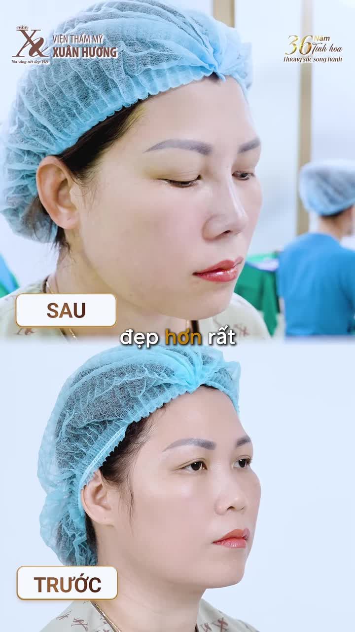 LỘT XÁC DIỆN MẠO TRẺ TRUNG, RẠNG RỠ CHỈ SAU 45 PHÚT NÂNG MŨI