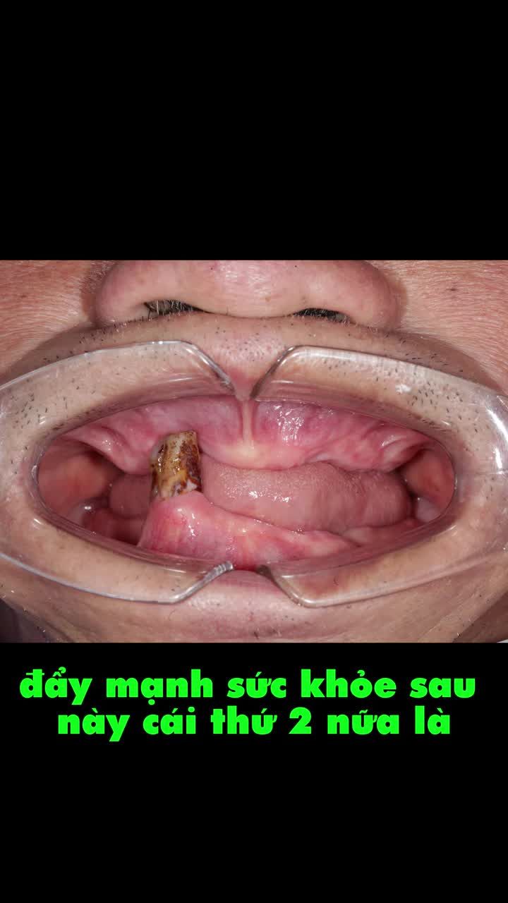 TRỒNG RĂNG CỐ ĐỊNH TOÀN HÀM ĐÃ THAY ĐỔI CHẤT LƯỢNG SỐNG CỦA CHÚ LÂM NHƯ THẾ NÀO?
