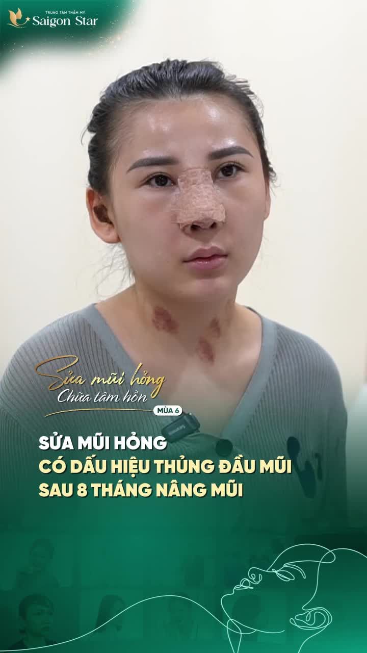 NÂNG MŨI ĐƯỢC 8 THÁNG ĐẦU MŨI CÓ DẤU HIỆU BỊ THỦNG MỜI CẢ NHÀ CÙNG BÁC SĨ HOẠT THEO DÕI HÀNH TRÌNH SỬA LẠI MŨI HỎNG CỦA BẠN KHÁCH ĐẾN TỪ THÁI LAN NHÉ!