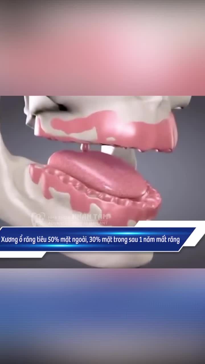 BEFORE – AFTER: KHẮC PHỤC TIÊU XƯƠNG HÀM VỚI GIẢI PHÁP IMPLANT TỨC THÌ