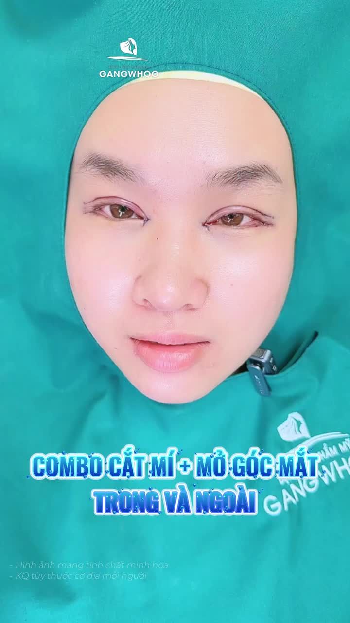 Hành trình ngày đầu đến làm đẹp đôi mắt tại Bệnh viện Gangwhoo.