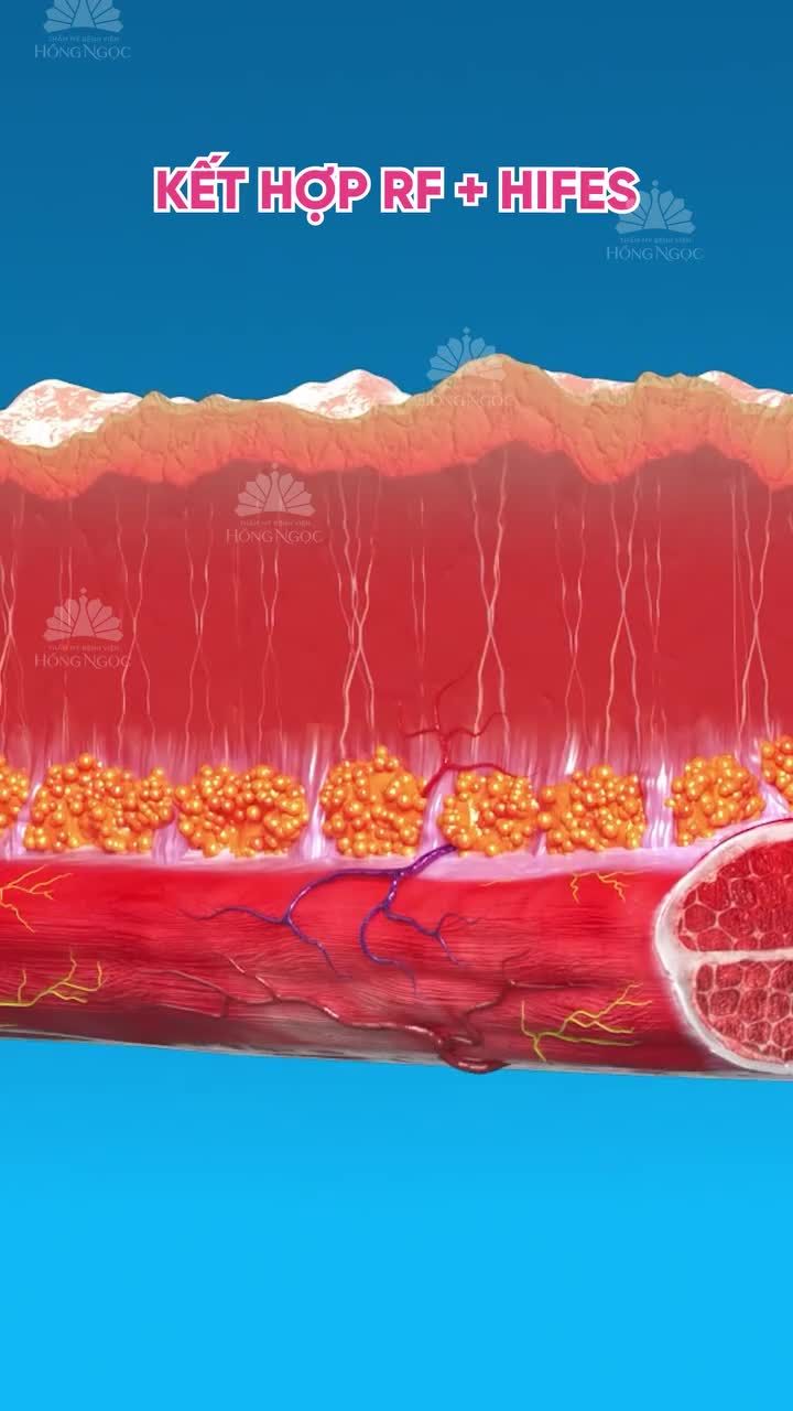 NÂNG CƠ SĂN CHẮC - XOÁ NHĂN TỰ NHIÊN CÙNG EMFACE