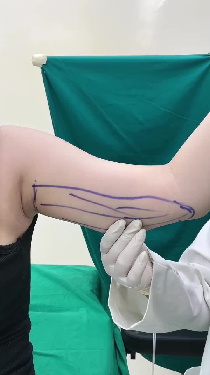 HÚT MỠ BẮP TAY TẶNG NGAY HÚT MỠ NÁCH!!