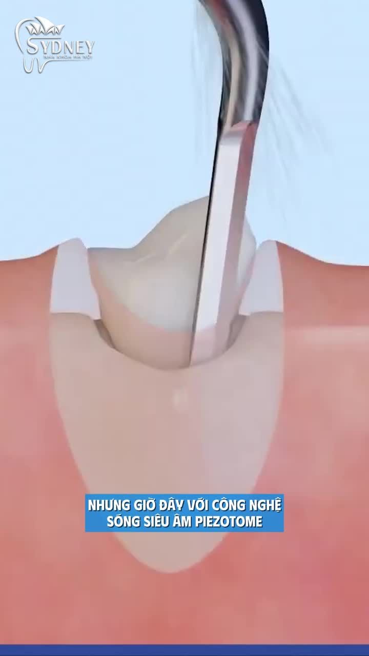 Nhổ răng khôn bằng công nghệ sóng siêu âm Piezotome