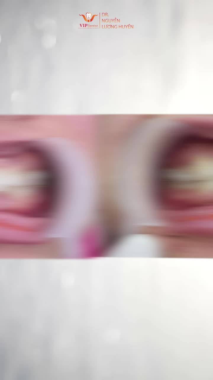 Niềng răng đẹp – Không nhổ răng tại VIP Dentist!