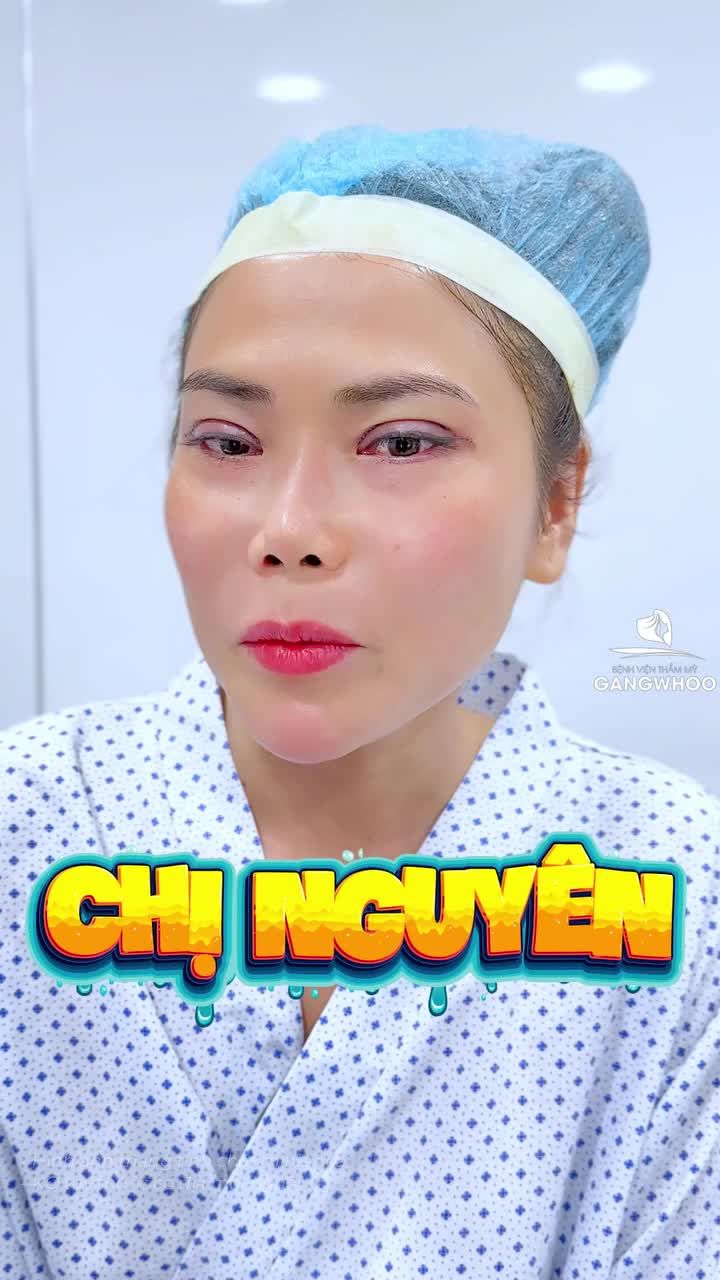 Sụp mí hay da chùng đều có giải pháp khi thực hiện tại Gangwhoo, mắt rạng rỡ ngay sau khi thực hiện.