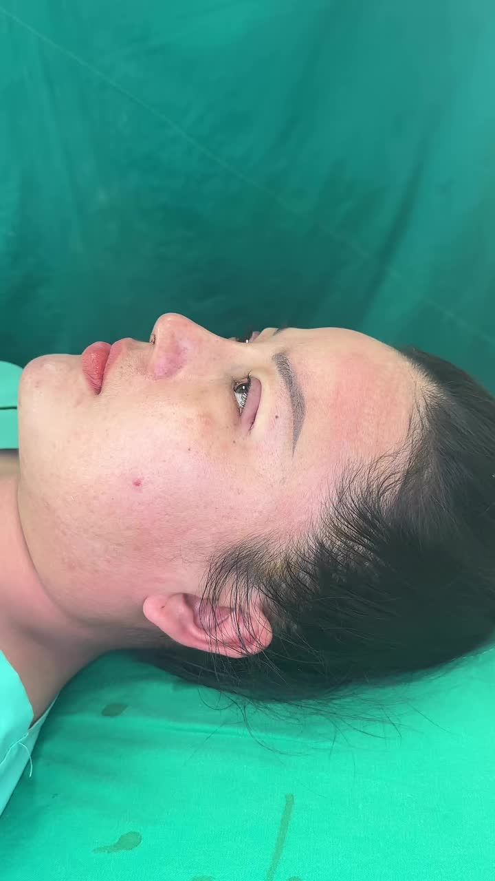 Case nâng mũi+ Độn cằm+ Cắt mí nâng cấp hoàn toàn gương mặt