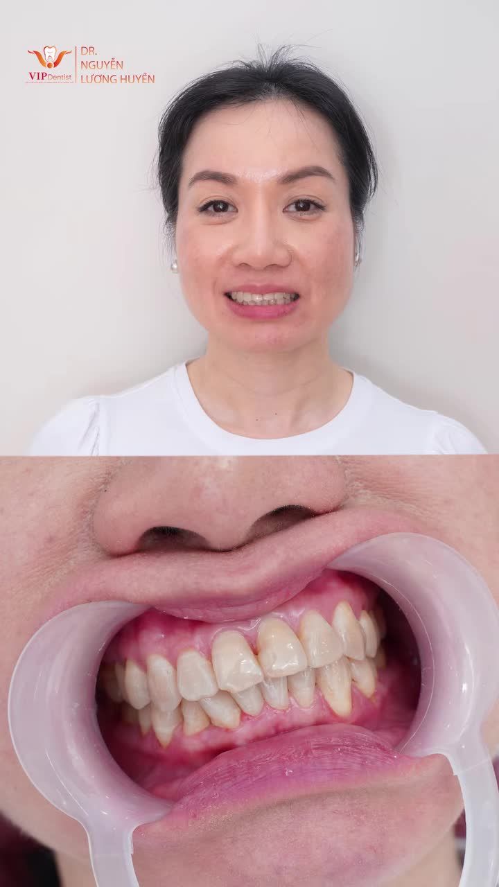 “Làm răng sứ xong mình thấy thay đổi quá, cảm giác cười tự tin hơn, nhan sắc cũng tăng lên hẳn mấy bậc!”